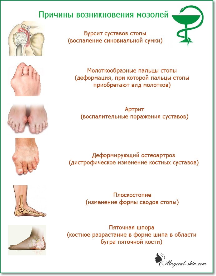 Лазерное удаление мозоли со стержнем