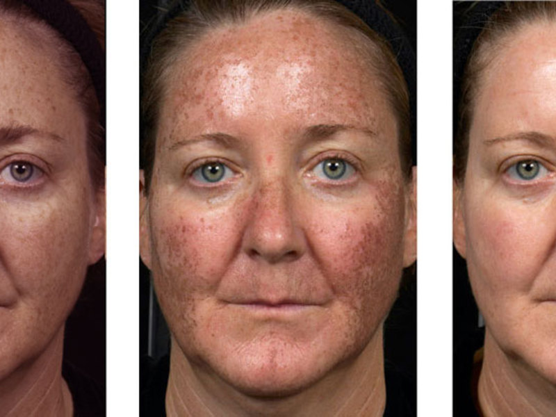 ???? лазерный пилинг кожи лица: эффект от пилинга лазером, показания и противопоказания