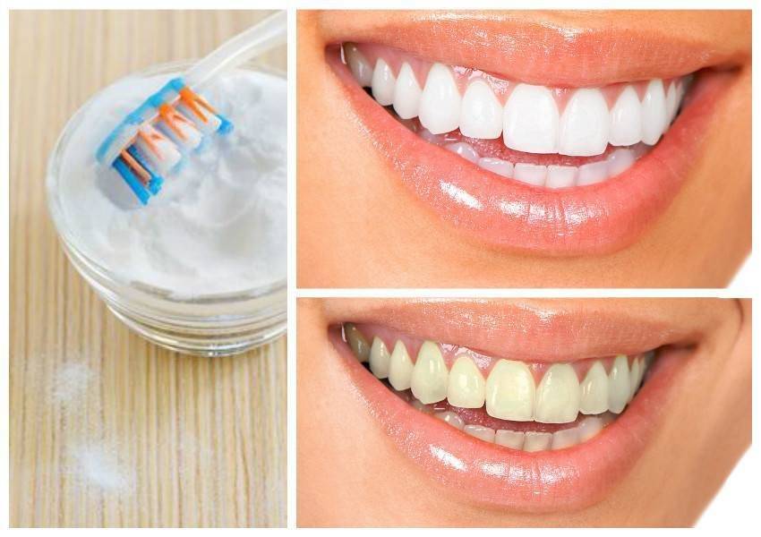 Отбеливание зубов содой в домашних условиях
