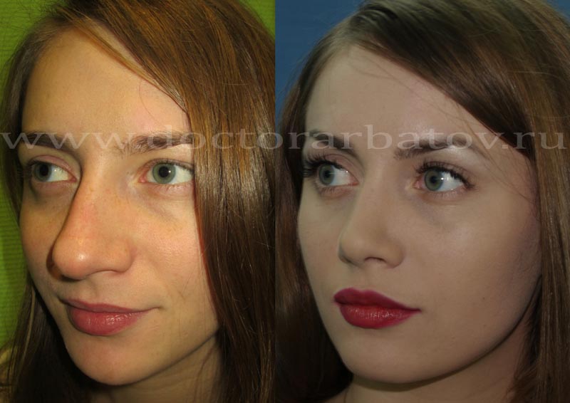 Ринопластика носа фото до и после женщины российские