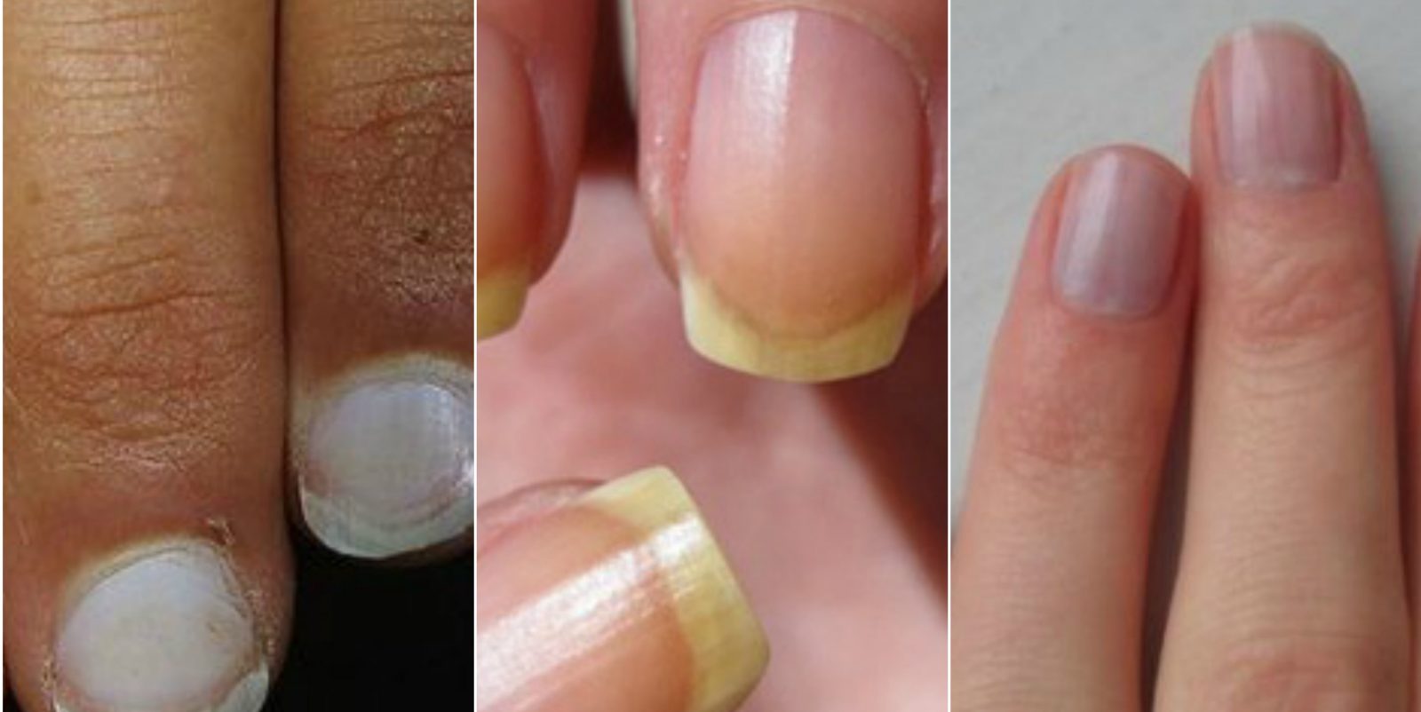 Ноготь желтый: желтые ногти: симптомы, причины | лечение и диагностика в балашиха — сеть клиник medical on group