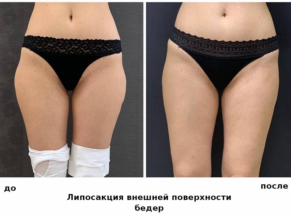 Липосакция бедер