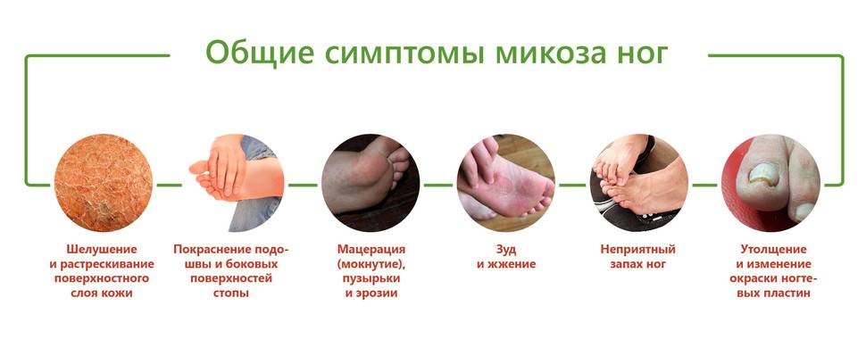 Онихогрифоз. симптомы, диагностика, лечение