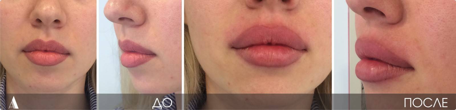5 эффективных методов, как поднять опущенные вниз уголки рта и разгладить морщины