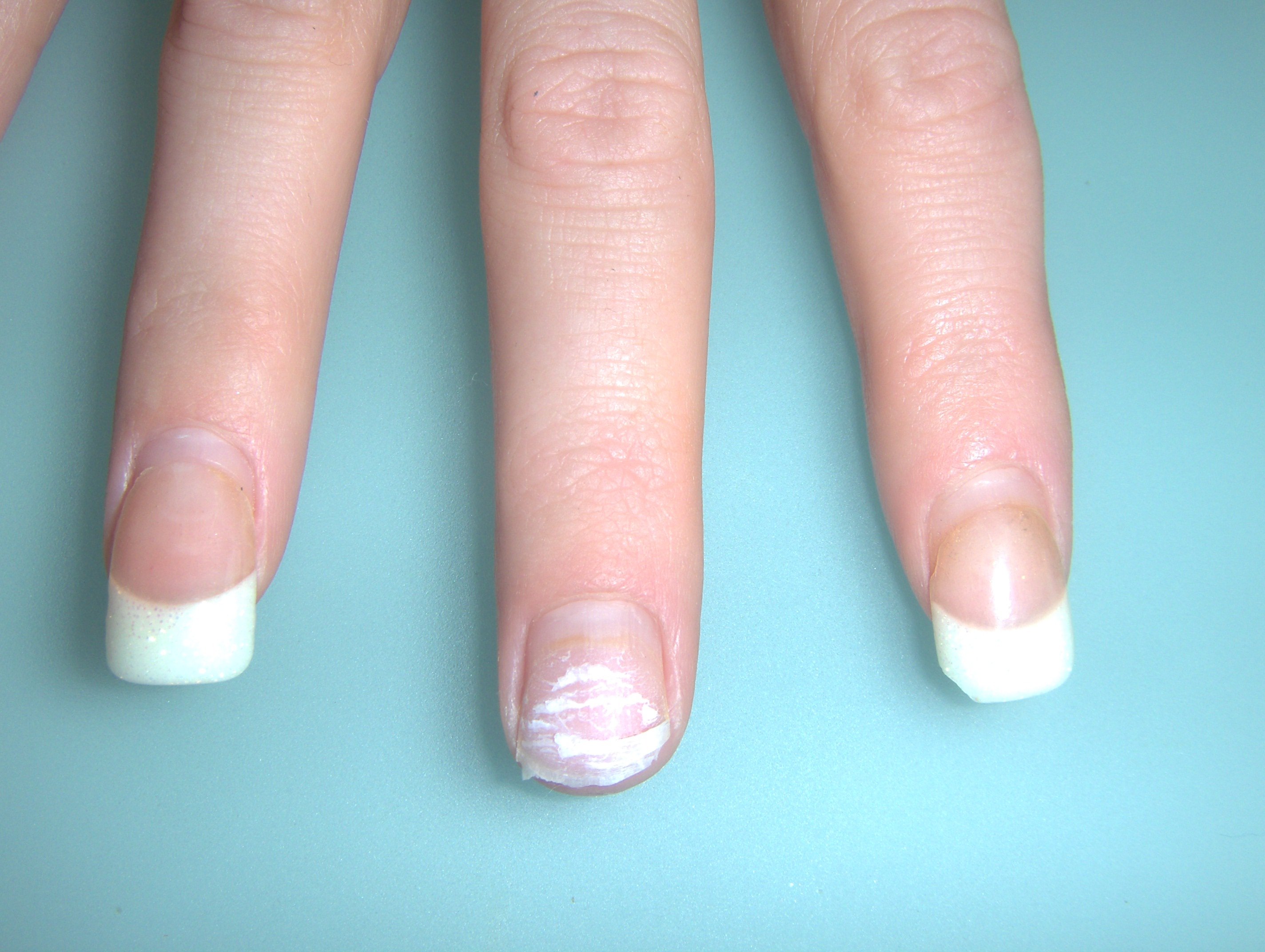 Ногти после наращивания — способы восстановления, методы лечения и советы по уходу (95 фото)