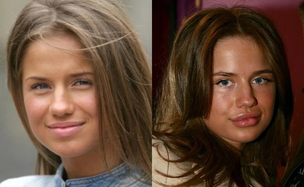 Анастасия певица фото до и после пластики