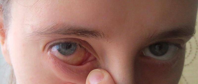 Аллергия на глазах: причины, симптомы, способы борьбы с отёками