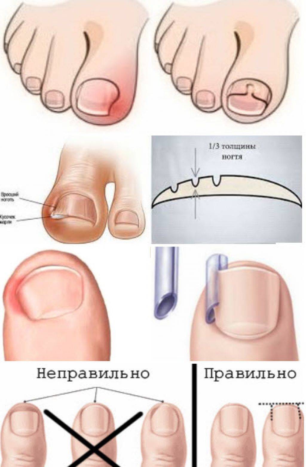 Удаление вросшего ногтя: методы проведения операции | food and health