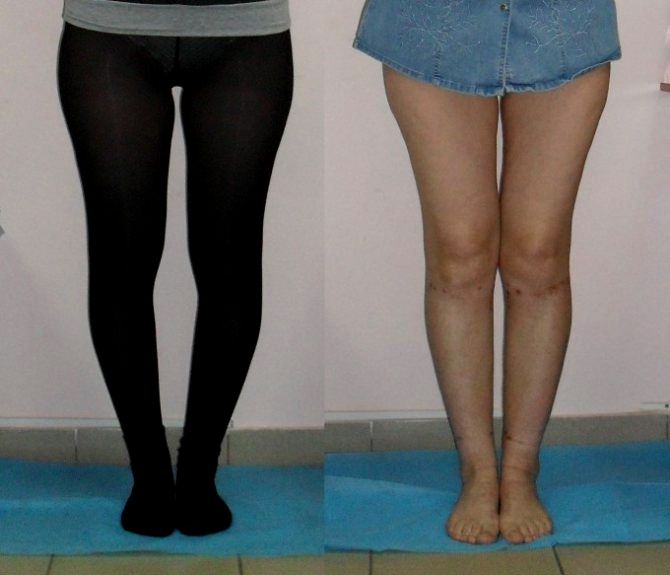 Как исправить кривые ноги у девушек, мужчин: в домашних условиях, с помощью упражнений
