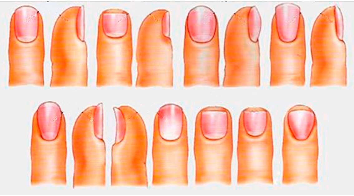 Дистрофические изменения ногтей