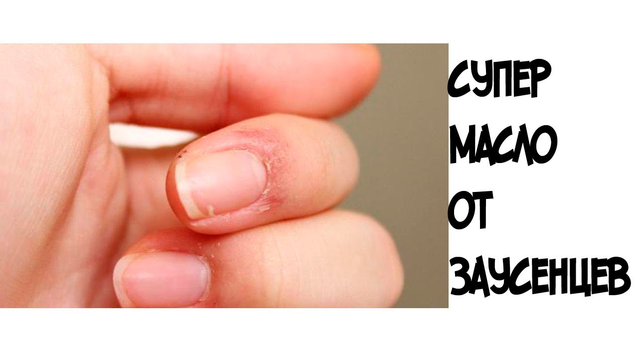 Заусенцы на пальцах — неправильный уход за ногтями.