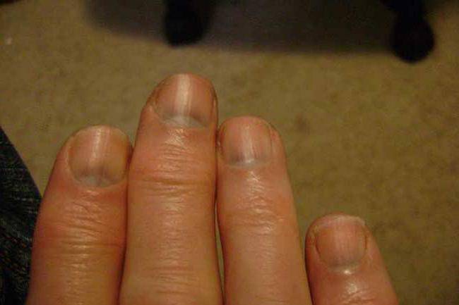 Почему синеют ногти на руках, обращаться ли к врачу? основные причины, способы лечения и профилактика