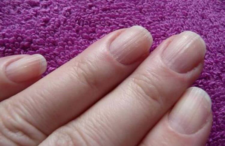 Волнистые ногти на руках, причины и лечение