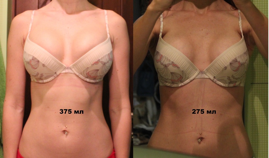 Операции по увеличению грудных желез. Цена, фото до и после, виды, показания, результаты
