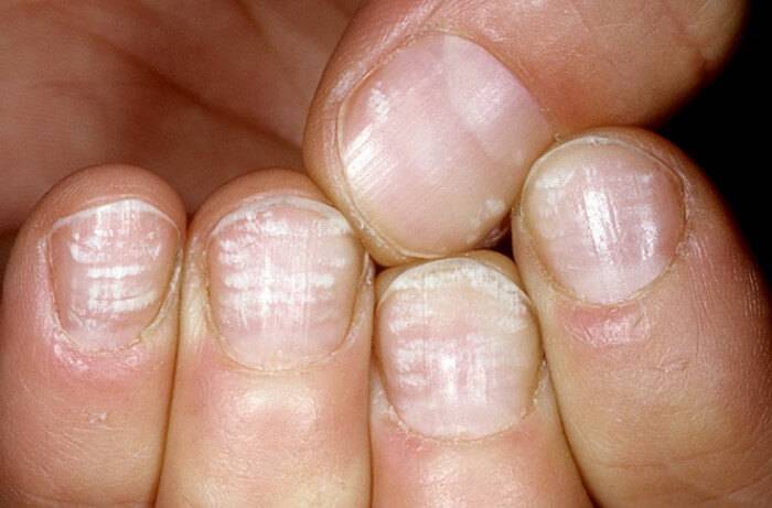 Белые полоски на ногтях– почему появляется лейконихия и как с ней бороться