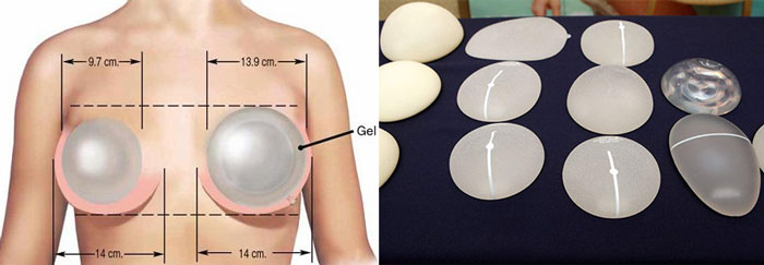 Грудные импланты — виды, установка, стоимость и фото до и после маммопластики
