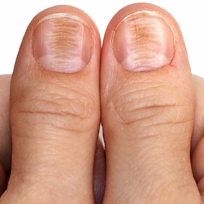 Как проверить щитовидку? три симптома гипотиреоза на ногтях!