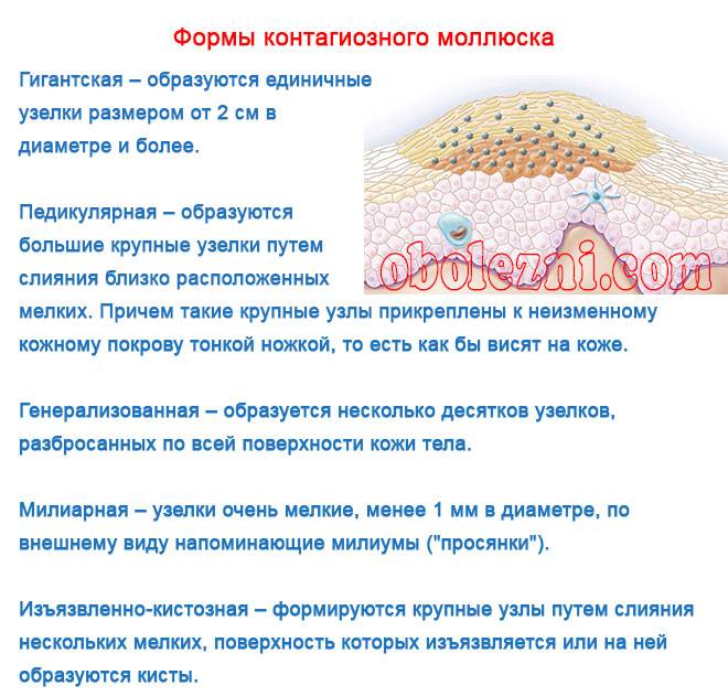Милиум или контагиозный моллюск?