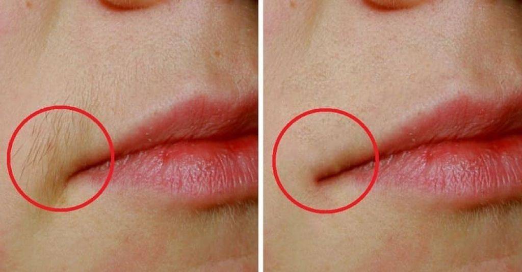 Эпиляция верхней губы: как убрать усики женщине в домашних условиях, можно ли их выщипывать пинцетом и другие способы, отзывы