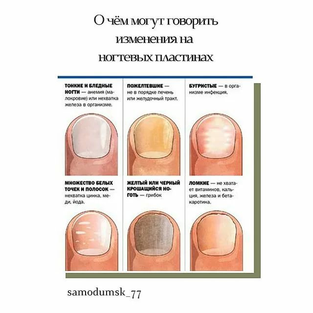 Лечение болезней и повреждений ногтей и кутикулы. о чём говорят деформации, ломкость и изменение цвета ногтей - медицинский центр «эхинацея»