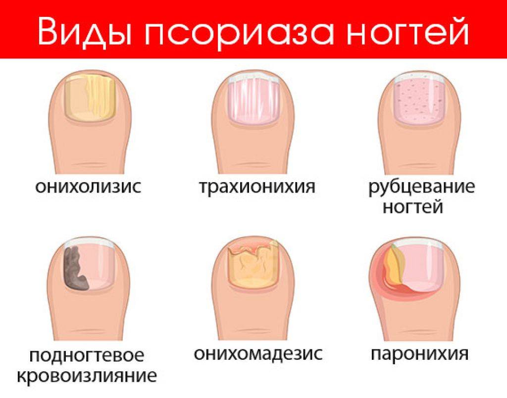 Желтые ногти: причины и лечение :: syl.ru