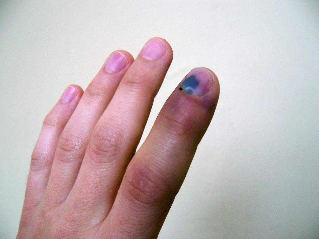 Травма ногтя