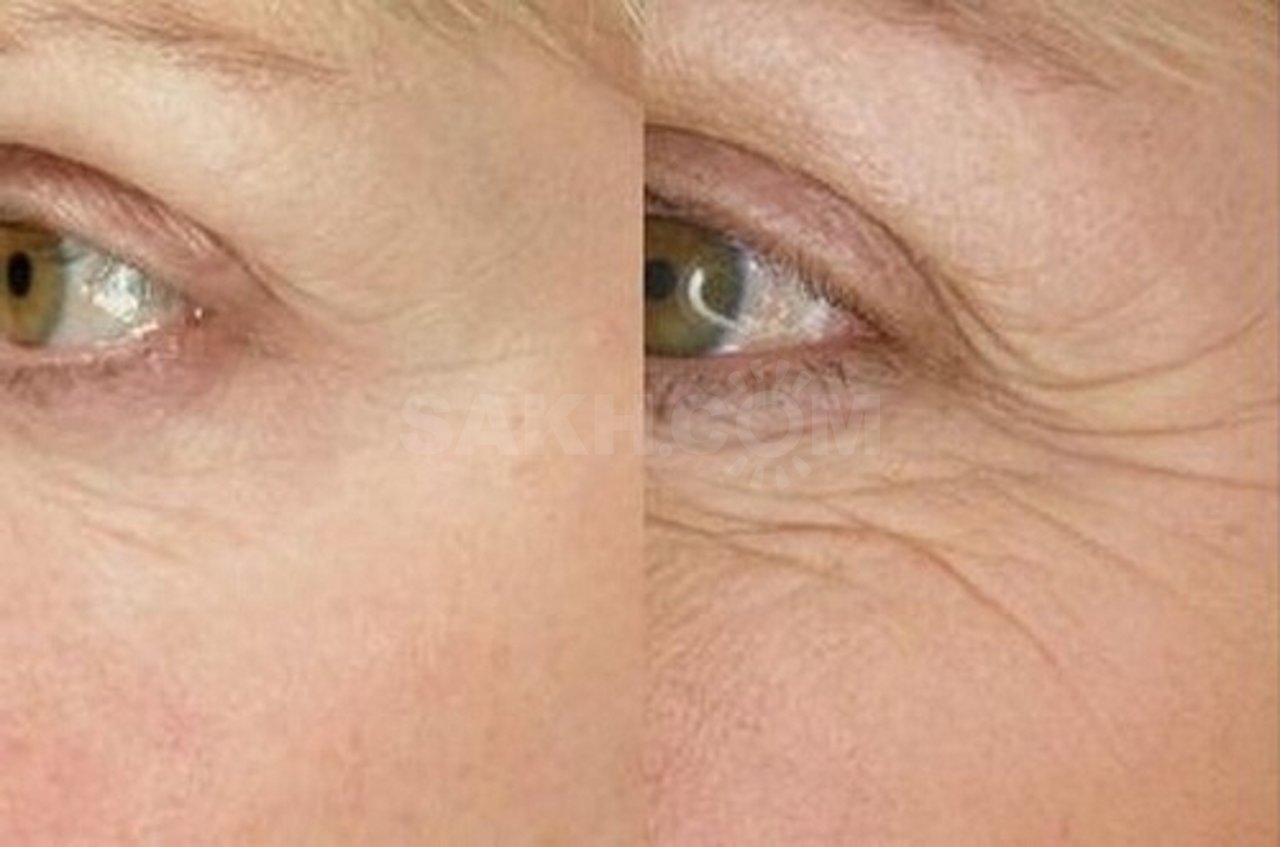 Мелкоморщинистый тип старения кожи лица: как бороться и что делать, фото, признаки морщинистого морфотипа, процедуры для ухода