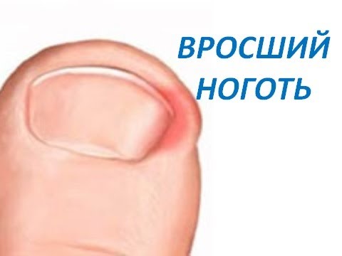 Вросший ноготь