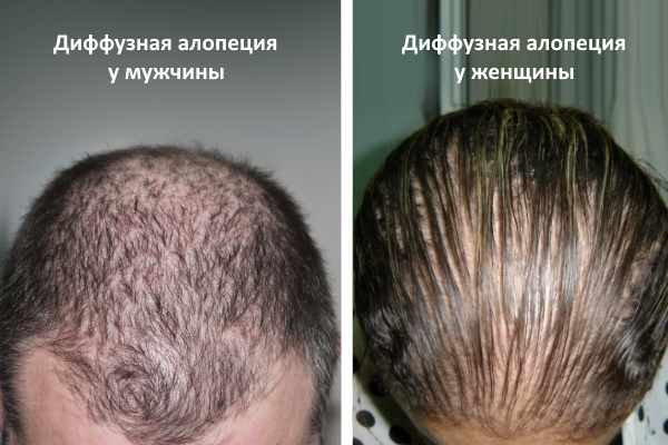 Диффузное телогеновое выпадение волос: вопросы диагностики и лечения в вашем городе