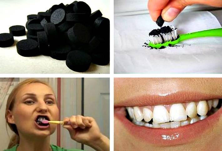 Отбеливание зубов углем - можно ли отбеливать зубы активированным углем