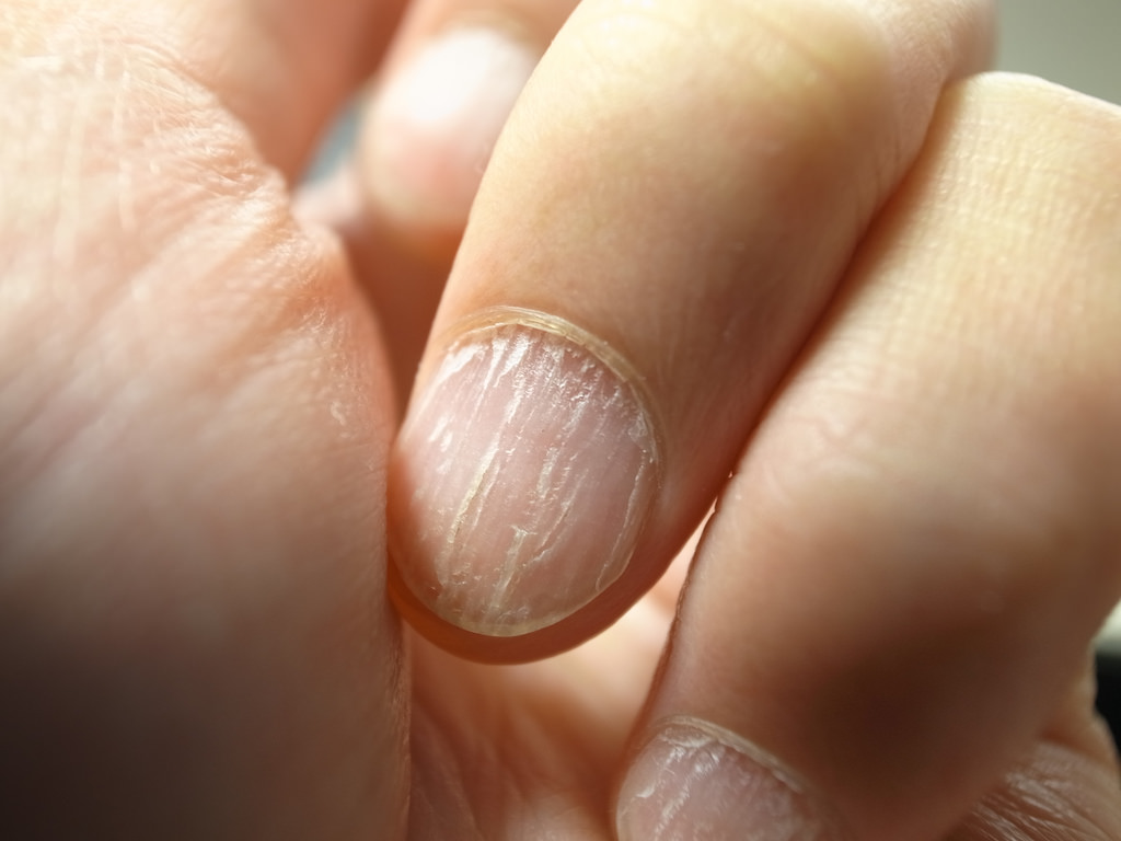 Сильно расслаиваются ногти: почему так?
