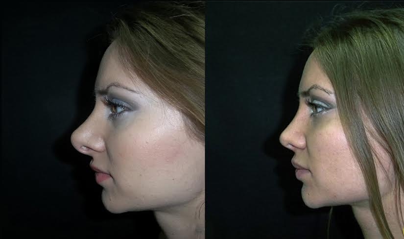 Большой нос у девушки. Фото до и после ринопластики