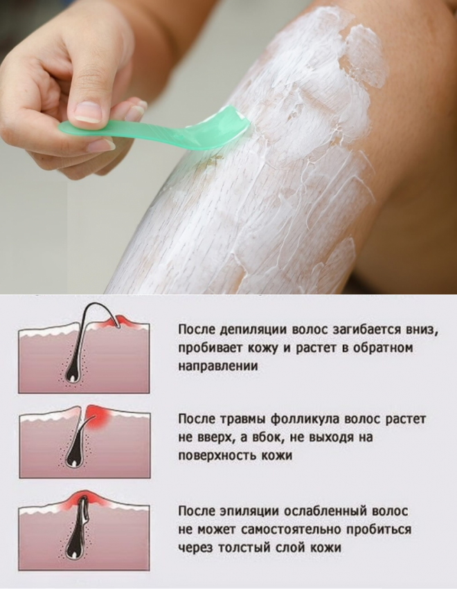 Шугаринг глубокое бикини на сколько хватает