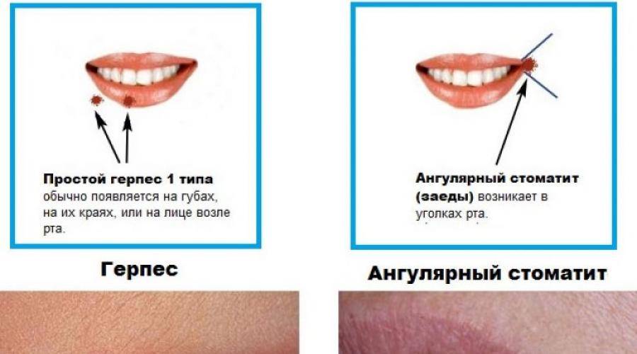 Стоматит и его виды. герпес как вид стоматита. причины и лечение.
