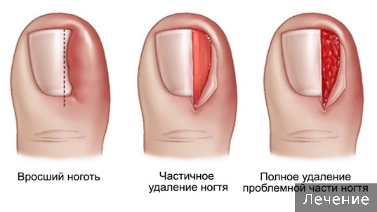 Удаление вросшего ногтя