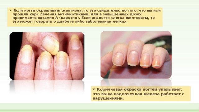 Лейконихия или белые пятна на ногтях​