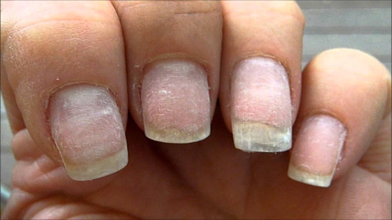 Как восстановить ногти после шеллака: восстановление после снятия и лечение в домашних условиях, как укрепить, если испортились