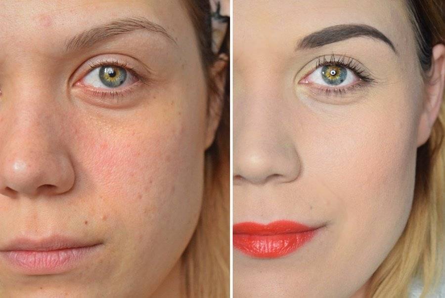 Как скрыть прыщи на лице с помощью макияжа