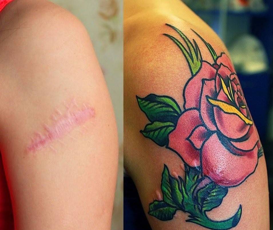Перекрытие шрамов татуировкой на руке