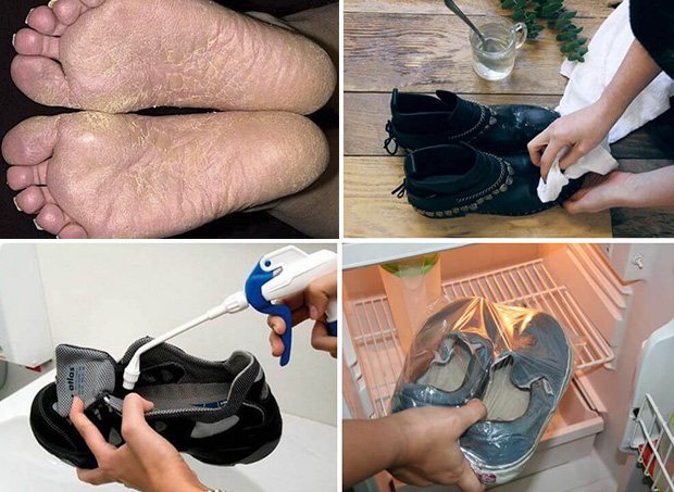 Способы дезинфекции обуви от грибка