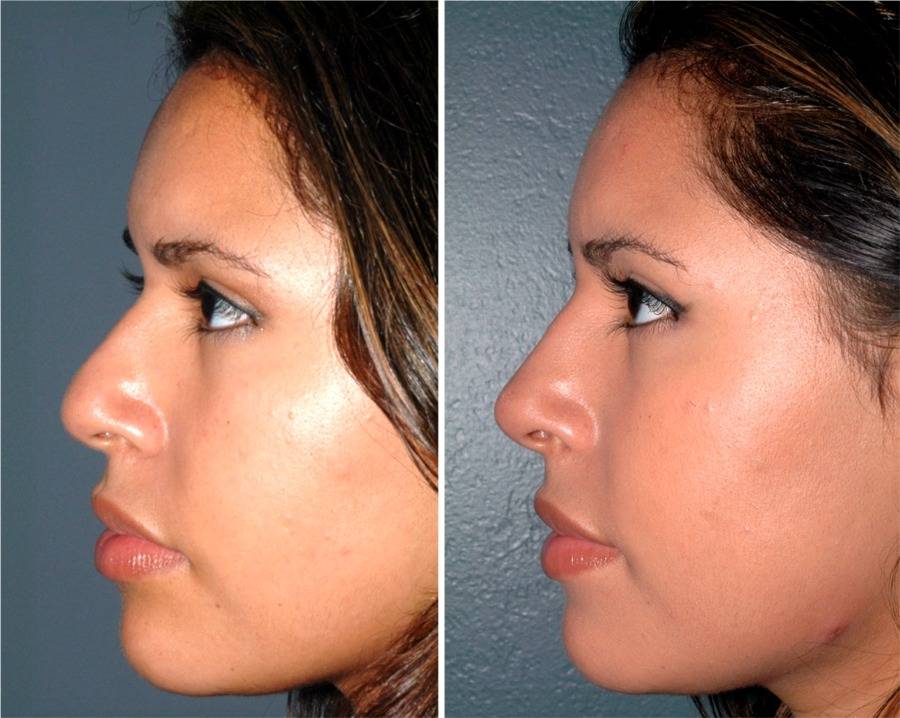 Как исправить нос картошкой у женщины. Ринопластика, фото до и после операции, цена
