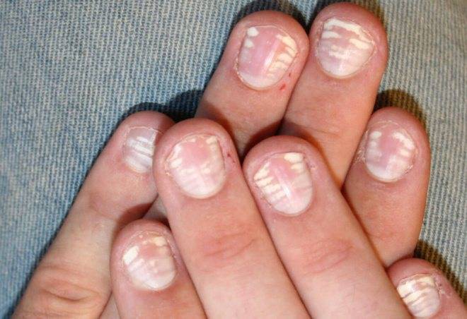 Белые полоски на ногтях- причины лейконихии, способы лечения » womanmirror
белые полоски на ногтях- причины лейконихии, способы лечения