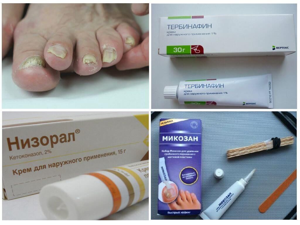 Ногтевой грибок на ногах: симптомы заболевания и особенности его лечения