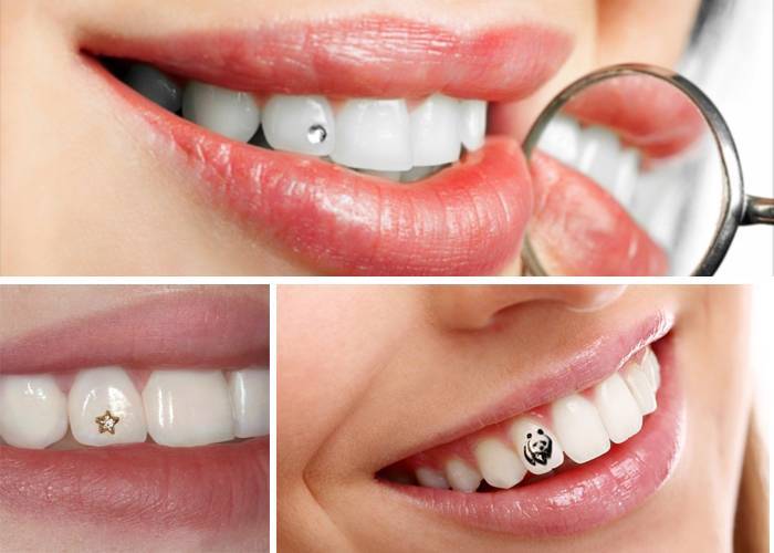 Урашение зубов скайсами: что это и фото пирсинга скайс