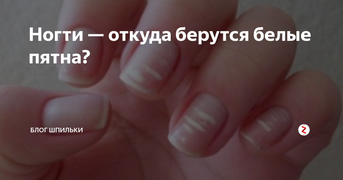 Как избавиться от белых пятен на ногтях - wikihow