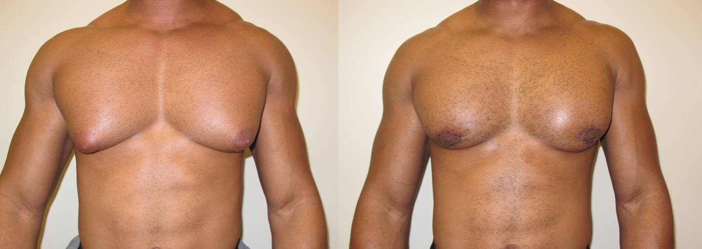 Гипопластические аномалии молочных желез: гипоплазия - недоразвитие груди. часть 1 | университетская клиника