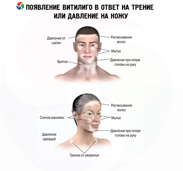 Витилиго - симптомы болезни, профилактика и лечение витилиго, причины заболевания и его диагностика на eurolab