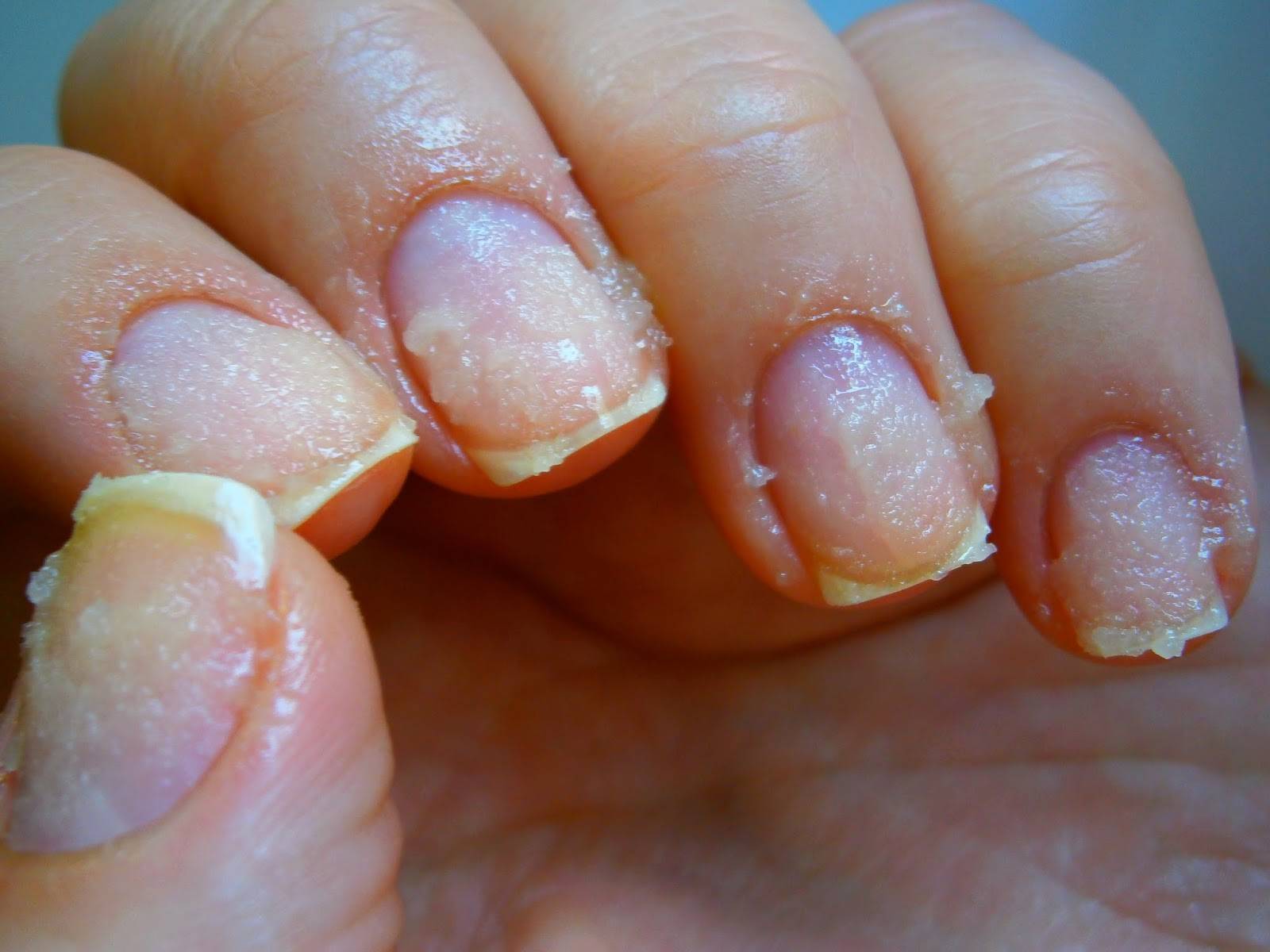 Расслаивание ногтей на руках. причины возникновения и эффективное лечение проблемы