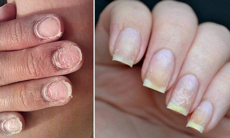Лечение грибка ногтей. как будут выглядеть ногти после процедуры?
