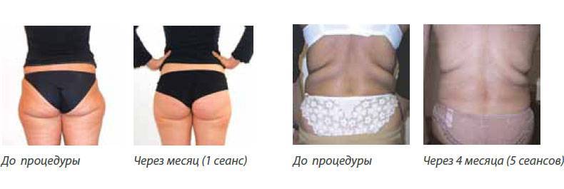 Какой метод удаления жира выбрать - криолиполиз, body tite или ультразвуковую липосакцию? - клиника косметологии
